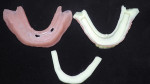 The two halves of the 3D-printed denture shown with the 3D-printed bar template.