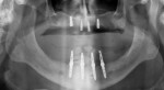 Final panoramic radiograph confirming the fit of the abutments.