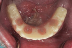 Buccal, occlusal, intaglio, and intraoral views of the completed denture.