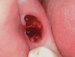View of compromised socket immediately following extraction.