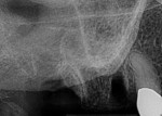 Postoperative radiograph after extraction.