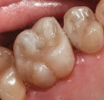 Postoperative view of the completed Class II restoration on tooth No. 3.