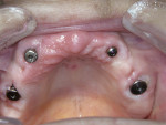 Figure 5  Six months after placement, healing abutments were placed on the upper left and right molar implants to begin the second stage of treatment.