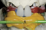 Figure 6  A jig was fabricated on the model with non-engaging cylinders, mocked-up acrylic teeth, bite registration, and stick bite.