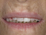 Figure 7  The implant bridge was tried in the patient’s mouth to confirm fit and allow the patient to try her restoration.
