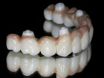 Figure 10  The lithium-disilicate crown blended well with the ceramic-layered restorations.