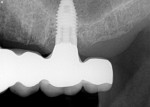 Figure 12  A radiograph was taken to confirm that the zirconia implant bridge fit the maxillary left implant.