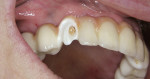 Figure 14  Before cementing the lithium-disilicate crown, the implant bridge access hole in the maxillary right canine position was filled with polyvinyl siloxane material to prevent the cement from blocking access.