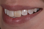 Fig 13. Close-up lateral smile view (45° left).