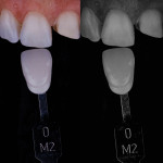 Fig 19. The shade photograph should include the tooth, shade tab, and the shade itself. It is not uncommon for the shade notation to be missing or incorrect, so this step provides a check for accuracy. Inclusion of a value photograph is critical because incorrect value is the most common reason that shades do not match.