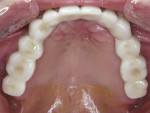 Figure 15  An occlusal view of the implant bridge demonstrates the natural appearance created with the ceramic veneering materials.