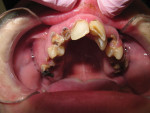 Fig 3. The patient presents with broken teeth.