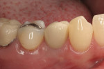 Figure 7  The 2-year follow-up photograph shows maintenance of gingival margin height and facial bone profile.