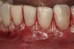 Figure 11  The facial periodontal-plastic flaps were sutured with 5-0 PTFE sutures.