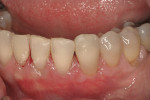 Figure 12  The 6-month follow-up shows thick gingival tissue and complete root coverage.
