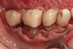 Figure 14  Facial flap was elevated and root notching was evident below the crown margins.