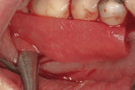 Figure 15  The porcine collagen in PRF was placed over the bony and recession defects.