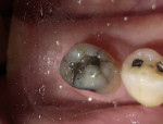 Figure 1  Tooth No. 20 displayed numerous cracks into the dentin, indicating that the tooth was structurally compromised.