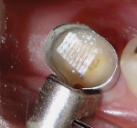 Figure 6  The field was then light-cured for 20 seconds to secure the Ribbond<sup>®</sup> to the dentin floor.