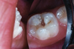 Occlusal caries lesion of the mandibular right primary second molar in a 39-month-old girl.