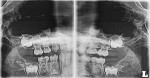 Panoramic radiograph reveals extent of caries lesion.