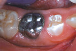 Clinical photograph taken 4 years and 8 months after treatment.