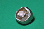 Crowned molar immediately after extraction.