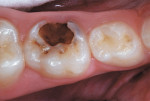 Nine-year-old boy with severe caries infection of primary molar.