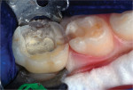 Pulpotomy and first molar preparation completed.