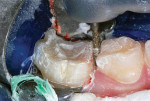 Disto-occlusal restoration of first molar cut to contour.