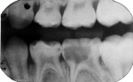 Pretreatment radiograph showing carious pulp exposure.