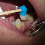 Figure 9  The restoration was loaded with the adhesive cement through its automix syringe, then brought to the tooth using the applicator stick.