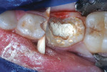 MTA pulpotomy completed and first primary molar prepared for restoration.