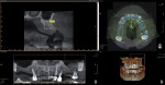 CBCT analysis indicating large maxillary sinuses as well as adequate bone height and width in the premaxilla area for dental implant placement.