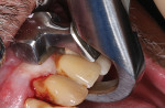 Minimally invasive extraction techniques were performed using an atraumatic extraction system.