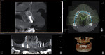 Postoperative CBCT image evaluating the strategic placement of the dental implants.