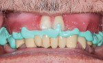 Conventional bite relations were made for the creation of esthetics prior to fabrication of the final zirconia prosthesis.