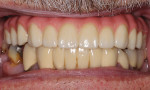 PMMA appliance fabricated by the laboratory to allow both the dentist and patient to evaluate form and function.