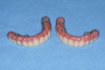 Side-by-side comparison of the PMMA transitional appliance and the final zirconia appliance.