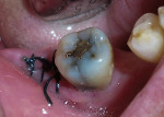Figure 11  A fracture on tooth No. 32 required surgical removal.
