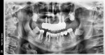 The final postoperative panoramic radiograph indicates a functional appliance.