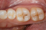 Preoperative view of the occlusal decay in the lower left first molar.