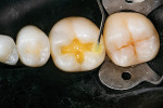 After tooth preparation, two coats of the universal adhesive were placed using the applicator.