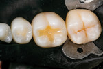 After curing, the flowable composite material transforms from translucent to an opacity closer to that of dentin.