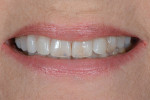 Fig 2. The full-smile 1:2 photograph further demonstrated the worn, thinning tooth structure.