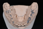 Fig 6. To ensure that the new maxillary
provisional restorations would fit the mounting, composite was spot-etched into place using the template of the mandibular arch.