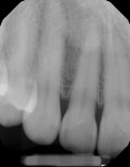 Fig 5. Maxillary right lateral periapical radiograph demonstrated good periodontal support of the teeth.