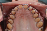 Fig 8. Prepared maxillary teeth ready for the impression.