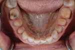 Fig 9. Preparation of the mandibular arch prior to the anterior teeth being fully prepared.