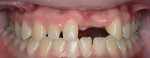 Fig 3. Intraoral view of missing teeth and ridge vertical height deficiency.